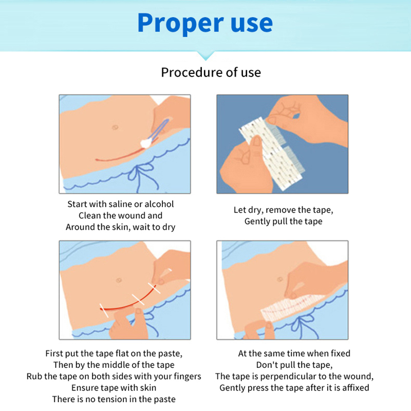 5 Strips Wound Skin Closure St - Medical Label review and price